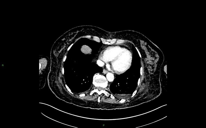Neo-terminal ileal stricture (Crohn disease) (Radiopaedia 33790-34948 A 6).jpg