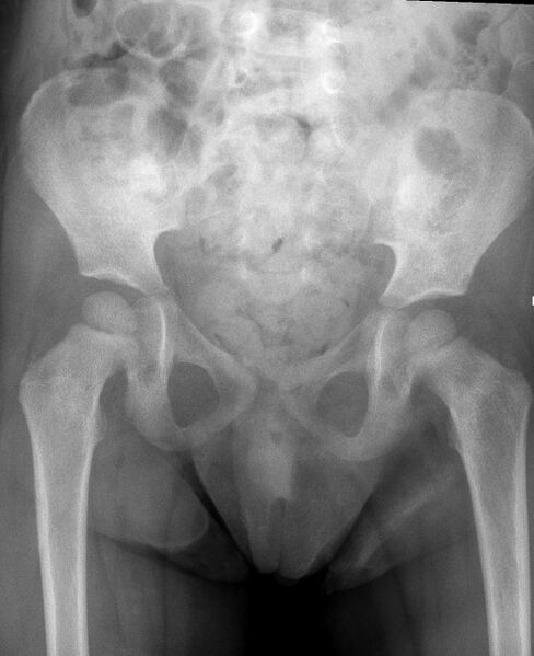 File:Neuroblastoma with bone metastases (Radiopaedia 67080-76410 Frontal 1).jpg