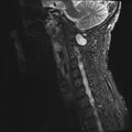Neurofibromatosis type 1 (Radiopaedia 80355-93740 Sagittal STIR 2).jpg