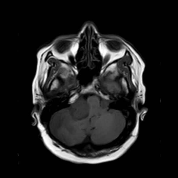 File:Neurofibromatosis type 2 (Radiopaedia 67470-76871 Axial T1 5).jpg