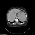 Non-Hodgkin lymphoma (Radiopaedia 27492-27690 B 23).jpg