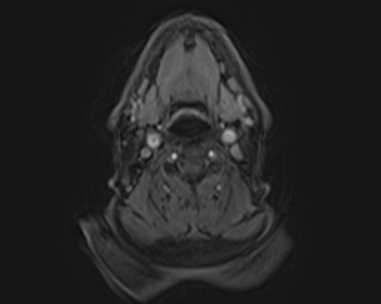 File:Non-Hodgkin lymphoma - parotid gland (Radiopaedia 71531-81890 E 2).jpg