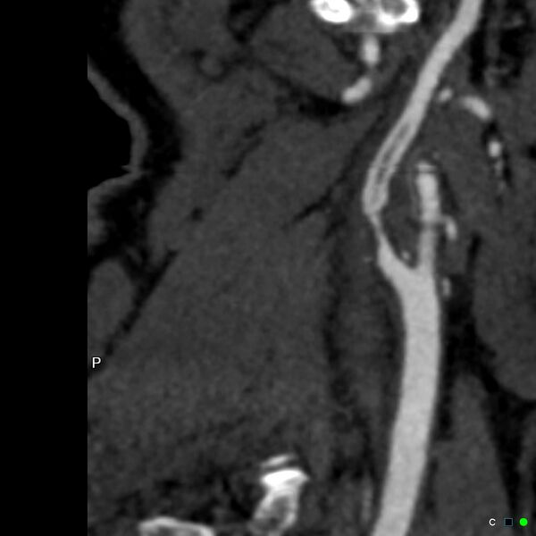 File:Non-occlusive intraluminal internal carotid artery thrombus (Radiopaedia 37751-39658 A 18).jpg