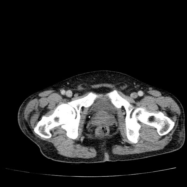 File:Non small-cell lung cancer (Radiopaedia 24467-24769 C+ delayed 117).jpg