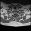 Normal cervical and thoracic spine MRI (Radiopaedia 35630-37156 Axial T1 C+ 8).png