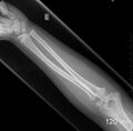 Normal elbow, radius and ulna x-ray - 6-year-old (Radiopaedia 53556-59584 Frontal 1).jpg