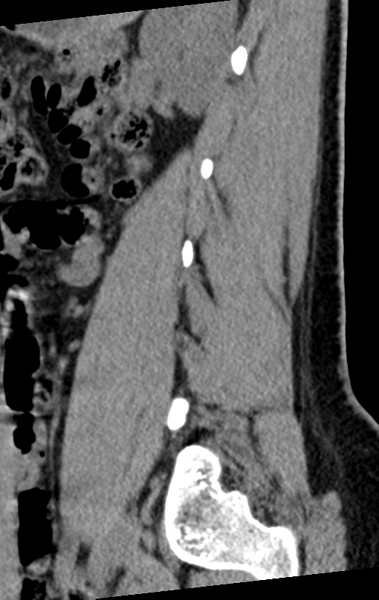 File:Normal lumbar spine CT (Radiopaedia 46533-50986 C 80).png