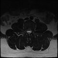 Normal lumbar spine MRI (Radiopaedia 47857-52609 Axial T2 3).jpg