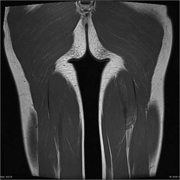 File:Normal muscles (Radiopaedia 24221-24491 Coronal T1 18).jpg