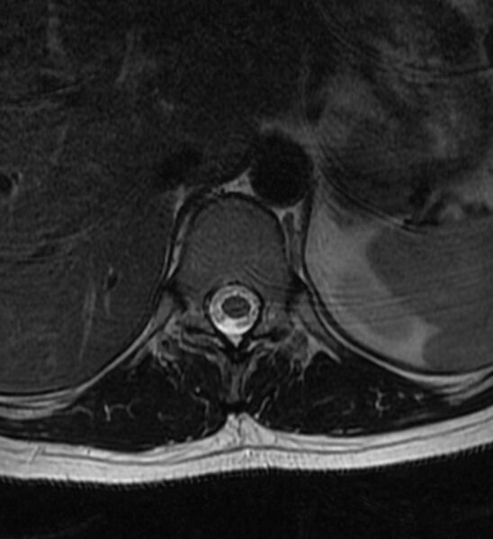 File:Normal thoracic spine MRI (Radiopaedia 41033-43781 Axial T2 21).jpg