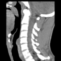 Normal trauma cervical spine (Radiopaedia 41017-43760 B 14).png