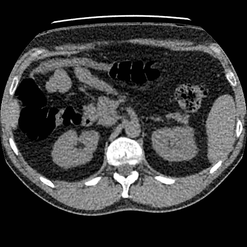 Obstructing ureteric calculus and ureteric anatomy (Radiopaedia 62730-71042 Axial non-contrast 23).jpg