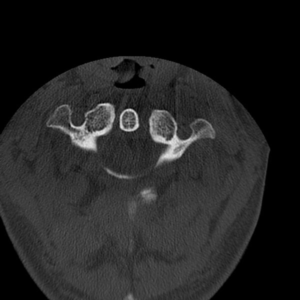 File:Occipital condyle fracture (Radiopaedia 31755-32691 Axial bone window 14).jpg