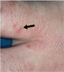 Scabies infestation with visible burrow