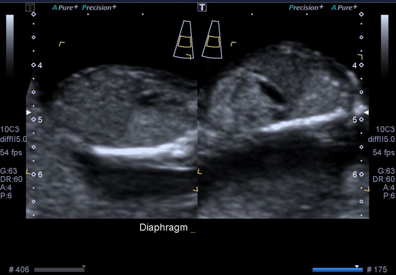 File:1st trimester nuchal-morphology ultrasound (Radiopaedia 44706-48477 General anatomy and NT 39).jpg