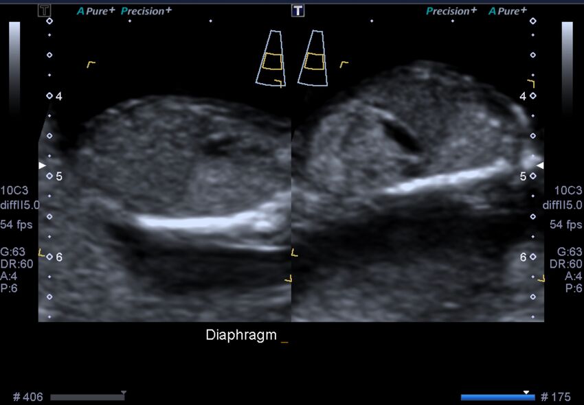 1st trimester nuchal-morphology ultrasound (Radiopaedia 44706-48477 General anatomy and NT 39).jpg