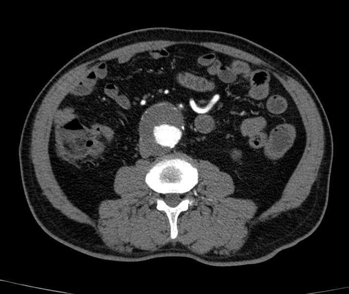 File:Abdominal aortic aneurysm (Radiopaedia 22421-22458 C+ arterial phase 49).jpg