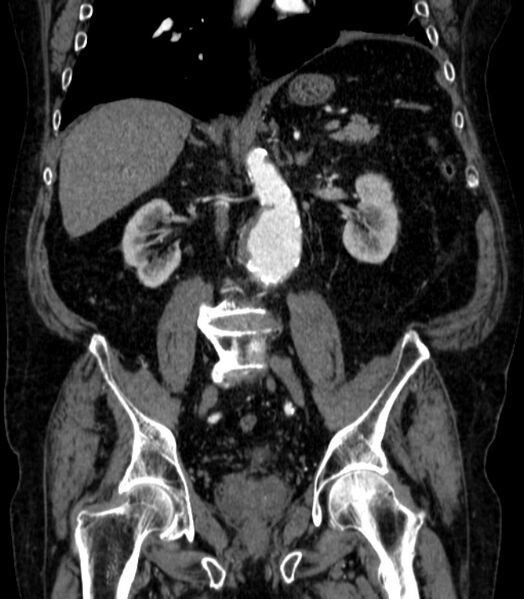 File:Abdominal aortic aneurysm (Radiopaedia 25855-26001 Coronal C+ arterial phase 40).jpg