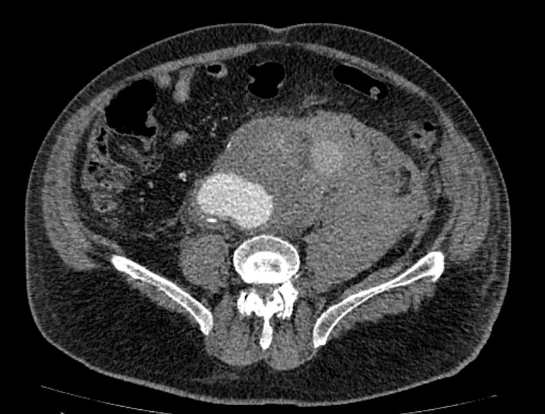 File:Abdominal aortic aneurysm rupture (Radiopaedia 54179-60362 Axial C+ arterial phase 40).jpg