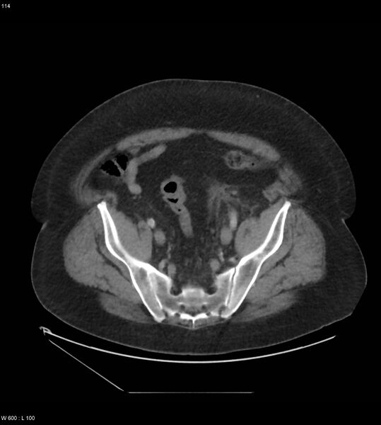 File:Abdominal aortic aneurysm with intramural hematoma then rupture (Radiopaedia 50278-55631 Axial C+ arterial phase 105).jpg