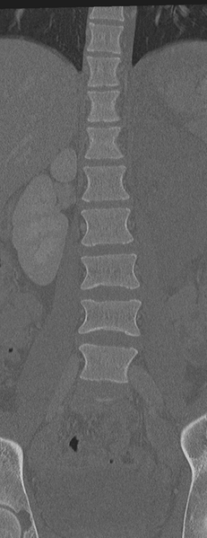 File:Abdominal multi-trauma - devascularised kidney and liver, spleen and pancreatic lacerations (Radiopaedia 34984-36486 Coronal bone window 23).png