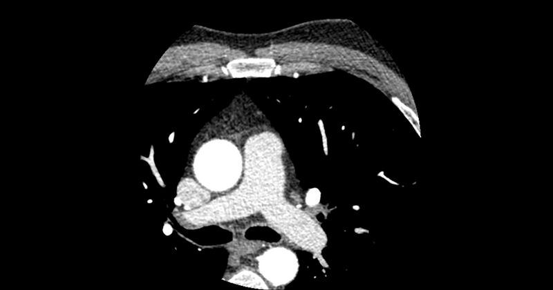 File:Aberrant left main coronary artery (ALMCA) arising from the right sinus with interarterial course (Radiopaedia 63251-71814 Axial C+ arterial phase 18).JPG