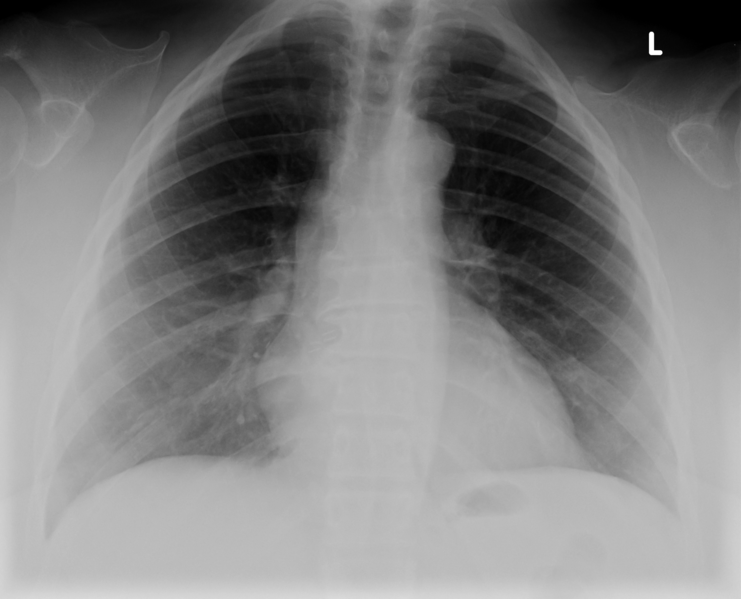 File:Absent clavicles (Radiopaedia 14566).png