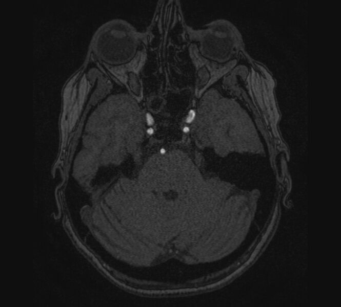 File:Accessory middle cerebral artery and ICA aneurysm (Radiopaedia 22656-22674 MRA 20).jpg