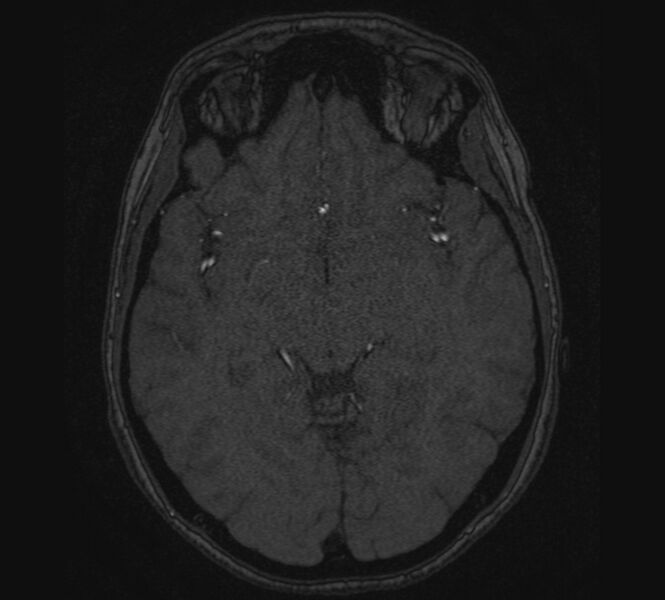 File:Accessory middle cerebral artery and ICA aneurysm (Radiopaedia 22656-22674 MRA 62).jpg