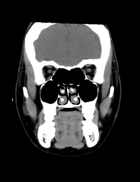 File:Accessory parotid glands (Radiopaedia 27289-27472 Coronal non-contrast 18).jpg