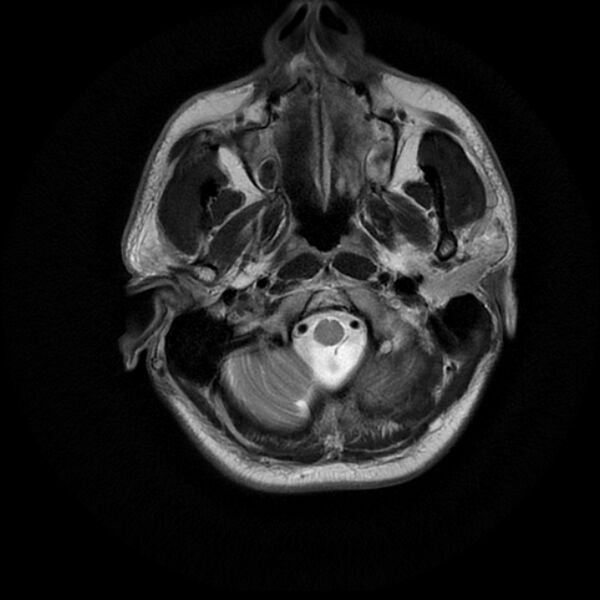 File:Acoustic schwannoma - intracanalicular (Radiopaedia 37247-39024 Axial T2 2).jpg