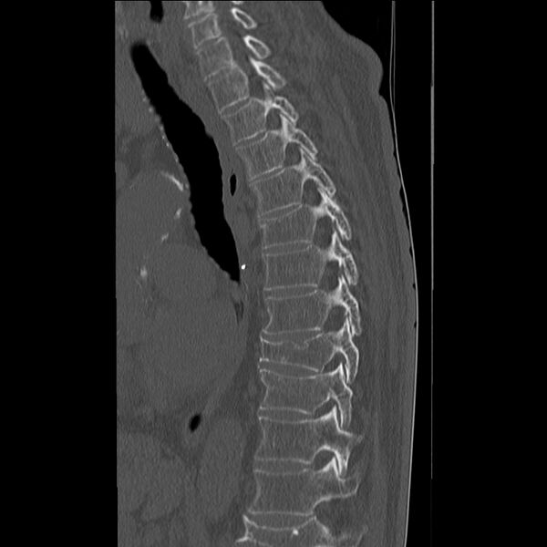 File:Acute and chronic vertebral compression fractures (Radiopaedia 31608-32494 Sagittal bone window 9).jpg