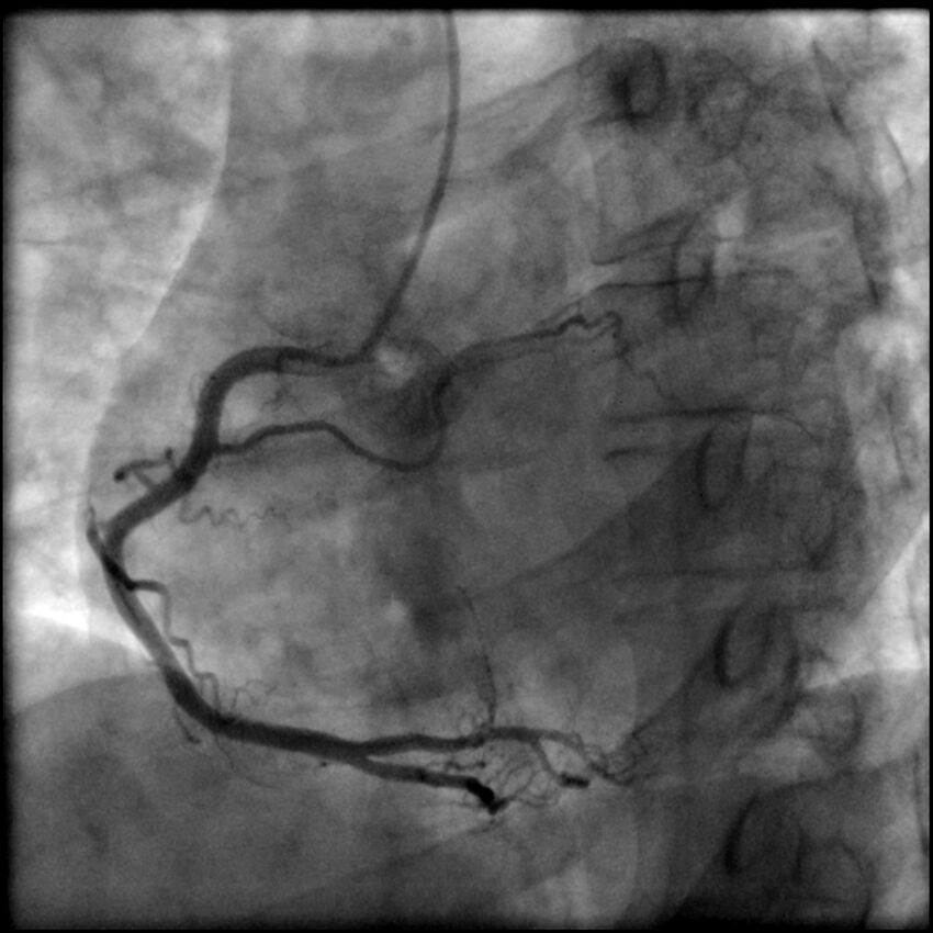 Acute anteroseptal myocardial infarction (Radiopaedia 68409-77946 RAO straight RCA 31).jpg