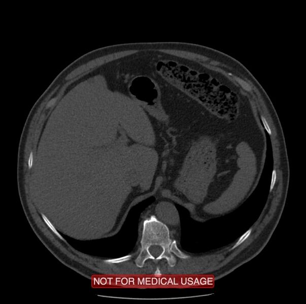 File:Acute aortic dissection - Stanford type A (Radiopaedia 40661-43285 Axial non-contrast 73).jpg