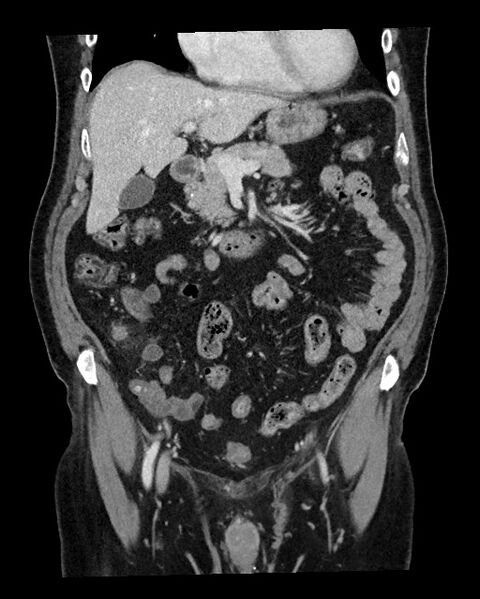 File:Acute appendicitis - large appendicoliths (Radiopaedia 61805-69820 Coronal C+ portal venous phase 51).jpg