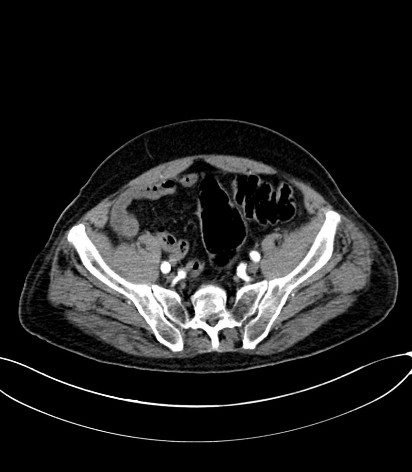 Acute arterial mesenteric ischemia (Radiopaedia 78238-90828 Axial C+ arterial phase 112).jpg