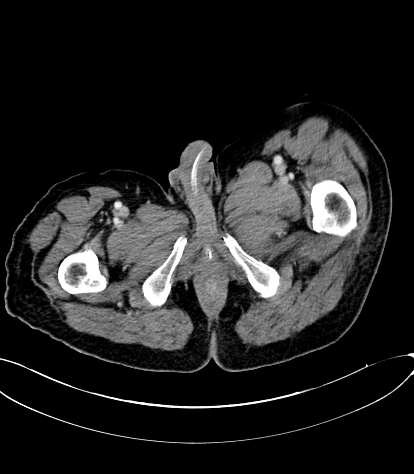 Acute arterial mesenteric ischemia (Radiopaedia 78238-90828 Axial C+ portal venous phase 156).jpg