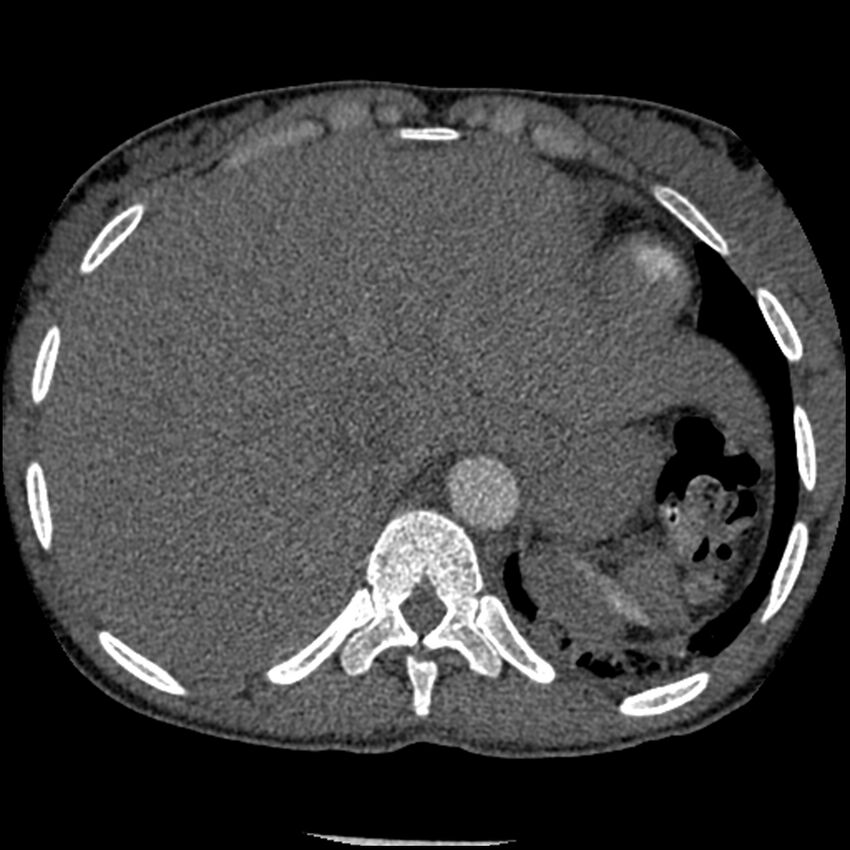Acute chest syndrome - sickle cell disease (Radiopaedia 42375-45499 Axial C+ CTPA 167).jpg