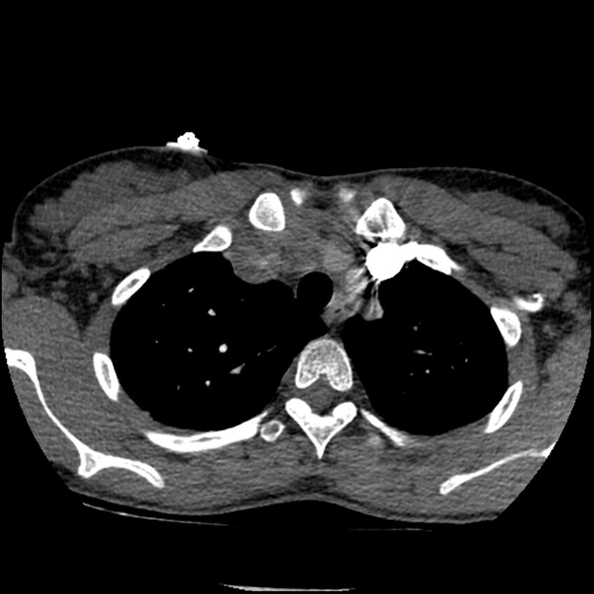 Acute chest syndrome - sickle cell disease (Radiopaedia 42375-45499 Axial C+ CTPA 38).jpg