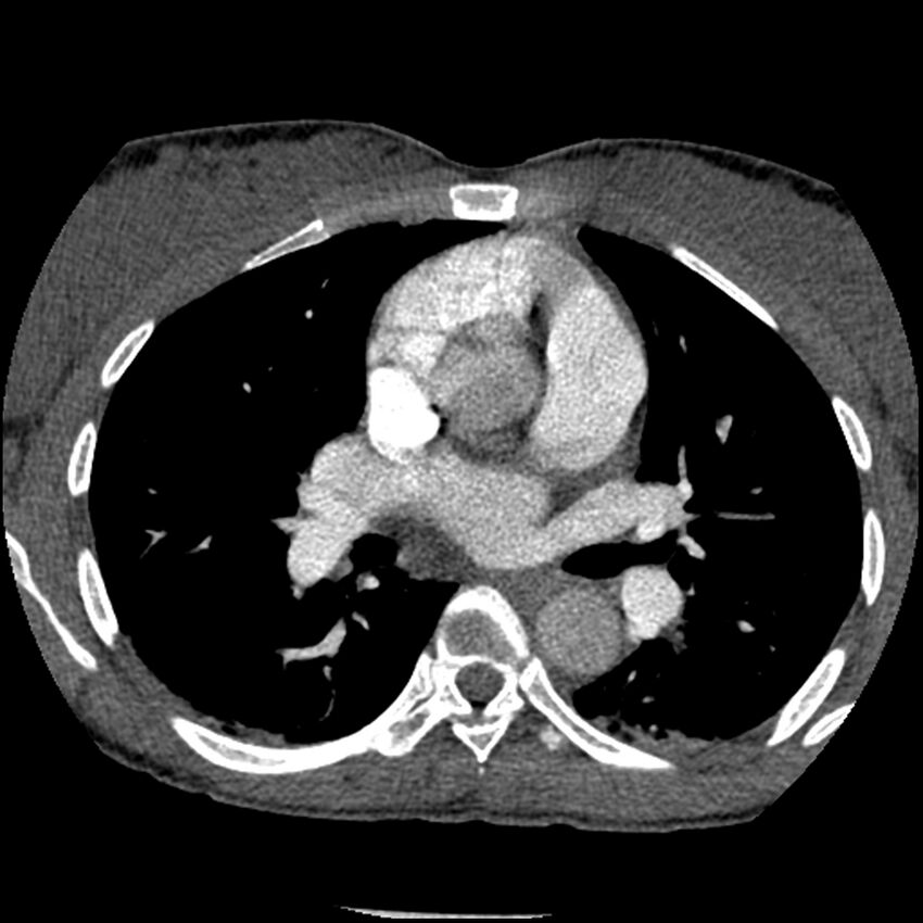 Acute chest syndrome - sickle cell disease (Radiopaedia 42375-45499 Axial C+ CTPA 88).jpg