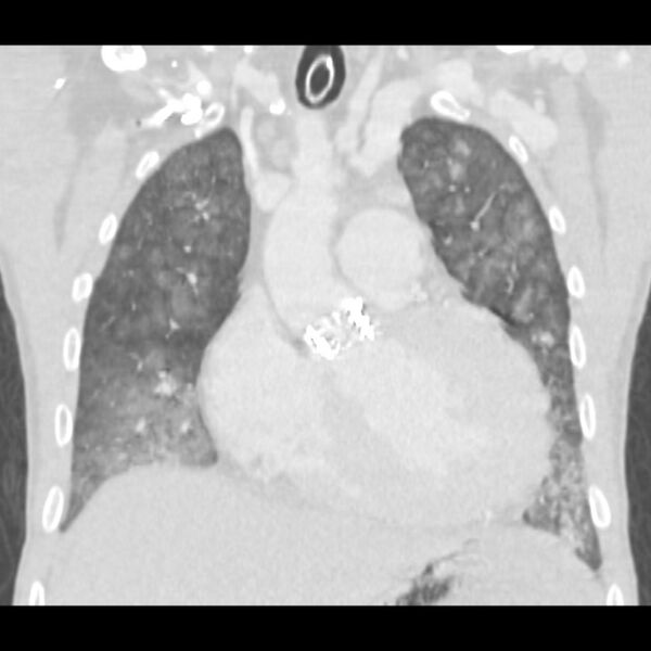 File:Acute diffuse alveolar hemorrhage (Radiopaedia 41323-44158 Coronal lung window 15).jpg