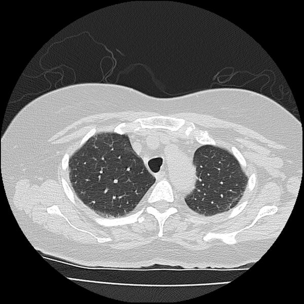 File:Acute interstitial pneumonitis (Radiopaedia 45404-49452 Axial lung window 20).jpg