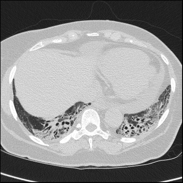 File:Acute interstitial pneumonitis (Radiopaedia 45404-49453 Axial lung window 62).jpg