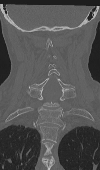 File:Acute on chronic subdural hematoma and thoracic vertebral injury in a multitrauma patient (Radiopaedia 31698-32619 Coronal bone window 39).jpg