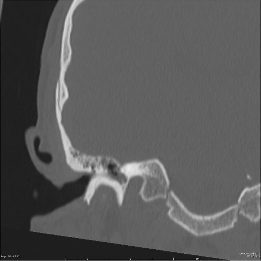 Acute otomastoiditis (Radiopaedia 28276-28512 Coronal PTB bone window reformat 22).jpg