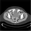 Acute pancreatitis (Radiopaedia 19136-19117 Axial C+ portal venous phase 38).jpg