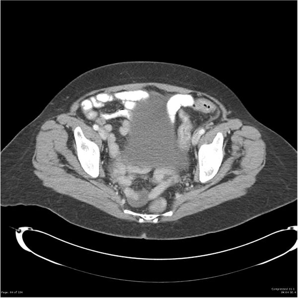 File:Acute pancreatitis (Radiopaedia 19136-19117 Axial C+ portal venous phase 38).jpg