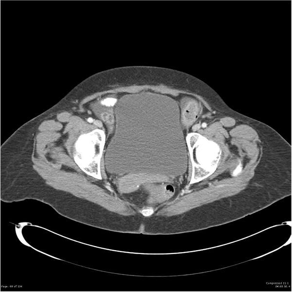 File:Acute pancreatitis (Radiopaedia 19136-19117 Axial C+ portal venous phase 40).jpg
