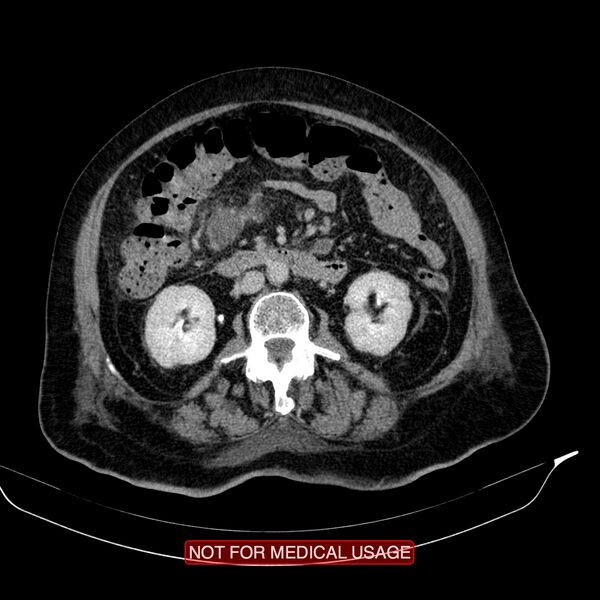 File:Acute pancreatitis with infected necrosis (Radiopaedia 26454-26585 Axial C+ delayed 19).jpg