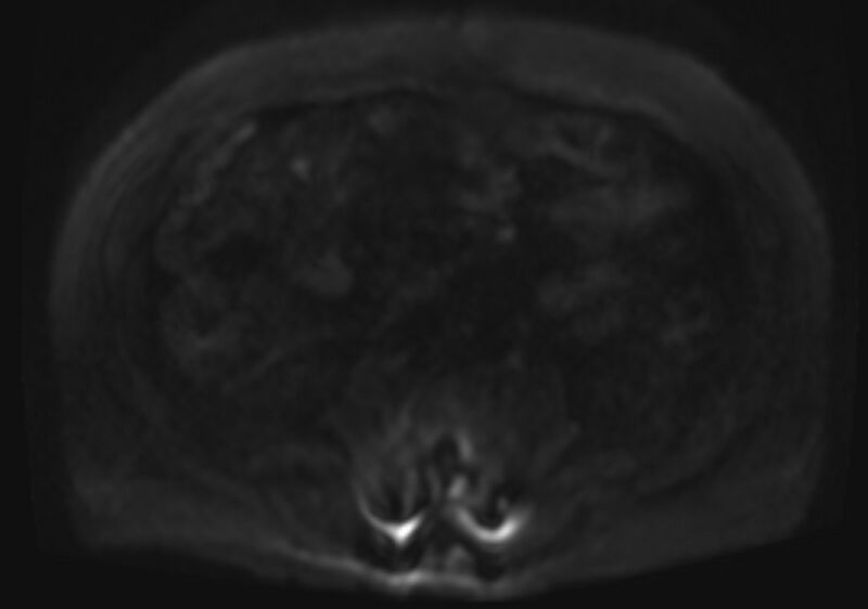 File:Acute portal vein thrombosis (Radiopaedia 73198-83925 Axial DWI 56).jpg